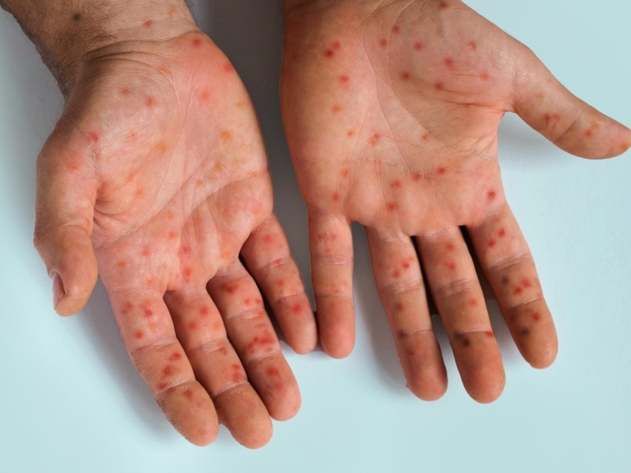 Kymera Stock Smashes 52-Week High as New Pill Crushes Eczema Markers